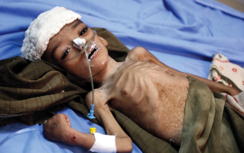الميليشيات تشترط علاج جرحاها مقابل تطعيم اليمنيين ضد الكوليرا