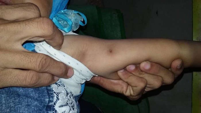 ظهور مرض جلدي مُعدي بين أطفال ردفان