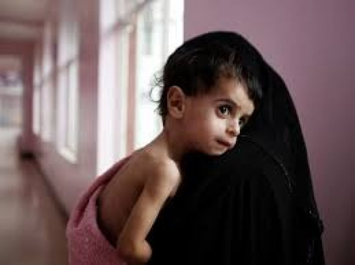 يواجهون الموت.. 400 ألف طفل يعانون سوء التغذية الحاد